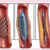 ASTM F3036 Testing of Absorbable Stents