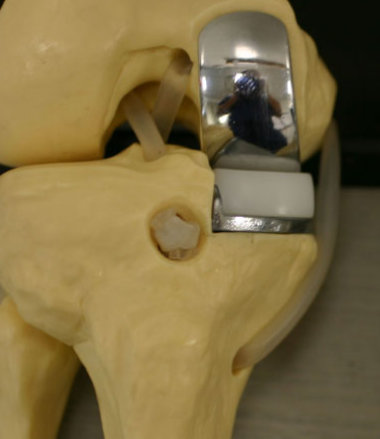 ASTM F2777 knee bearing (tibial insert) endurance fatigue test and deformation under high flexion