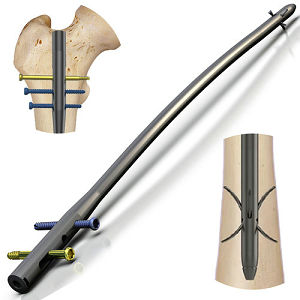 ASTM F1264 Intramedullary Fixation Device Torsion