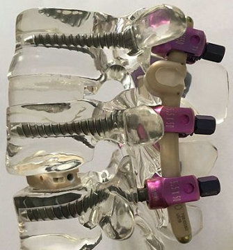 ISO 12189 Tests on Screw and Rod Systems for the Spine