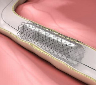 ASTM F2477 Test for in-vitro Pulsatile Durability Testing of Vascular Stents