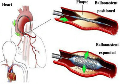 ASTM F2477 Test for in-vitro Pulsatile Durability Testing of Vascular Stents
