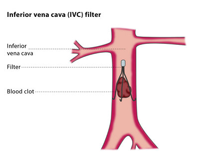 ISO 25539-3 Test methods of cardiovascular implants - Vena cava filters